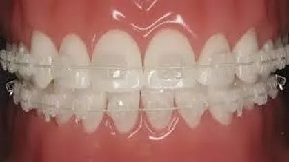 Tooth-coloured ceramic braces treatment at Revive Dental, Vajarahalli