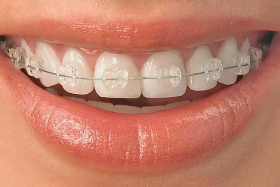 Close-up of ceramic braces on teeth