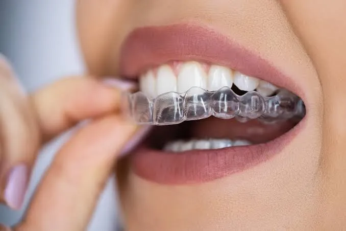 Patient wearing a clear plastic aligner tray