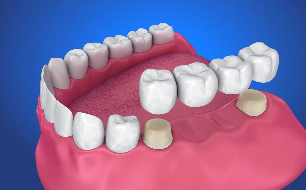 Dental crowns and bridges at Revive Dental, Banashankari 6th Stage