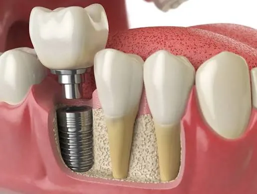 Dental implant procedure at Revive Dental, Vajarahalli