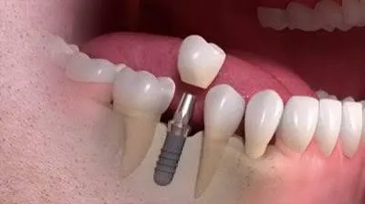 Cross-section model of a dental implant showing the titanium root and crown