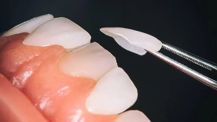 Dental laminates treatment at Revive Dental, Vajarahalli