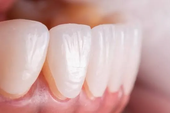 Laminate fitting procedure at a Bengaluru dental clinic