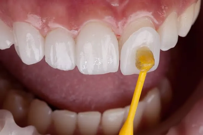 Dental veneer shade matching for a patient