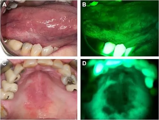 Diagnosis of oral potentially malignant disorders at Revive Dental