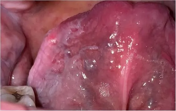 Clinical evaluation of an oral mucosal lesion