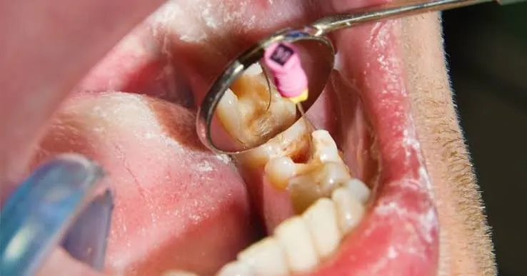 Endodontic surgery at Revive Dental, Vajarahalli, South Bangalore