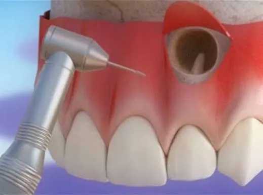 Endodontic surgery procedure near tooth root