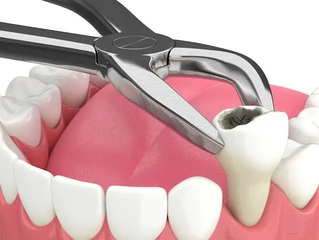 Dentist performing a tooth extraction near Thalaghattapura