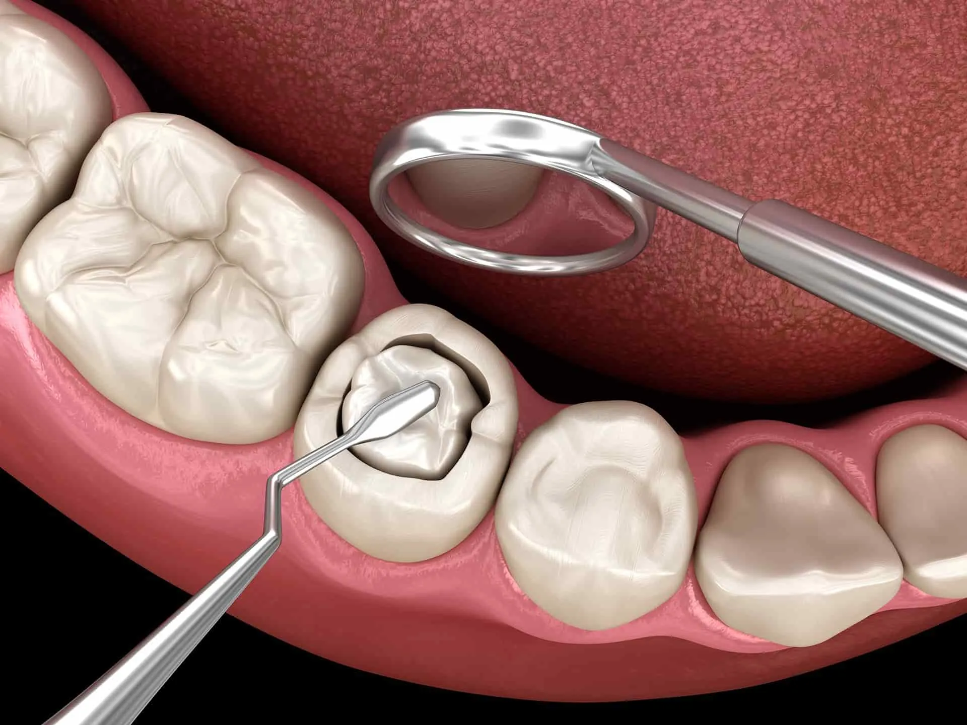 Tooth-coloured dental fillings for patients from Thalaghattapura and Konanakunte at Revive Dental