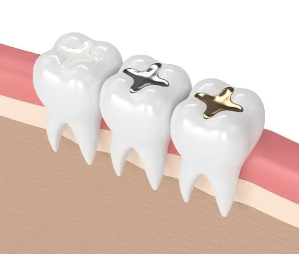 Close-up of pediatric dental filling procedure on a baby tooth