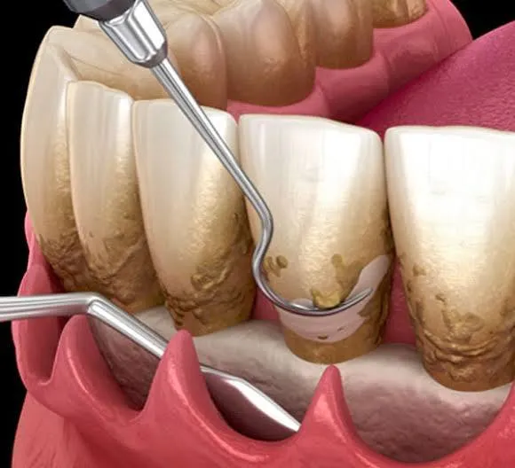 Gum surgery procedure in progress near Doddakallasandra