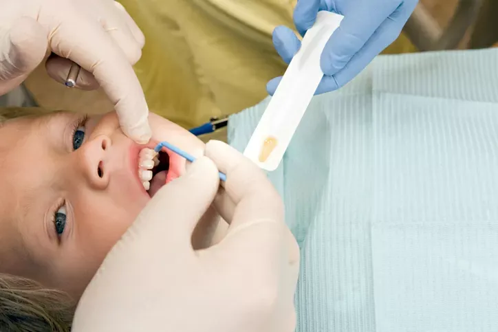 Fluoride therapy being applied to a child's teeth at Revive Dental