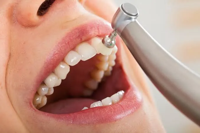 Pediatric dentist applying fluoride varnish to strengthen enamel