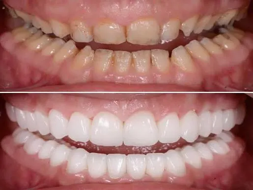 Full mouth rehabilitation consultation at Revive Dental clinic, Banashankari Stage 6