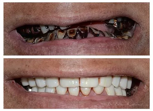 Before and after comparison photo of a full mouth rehabilitation treatment result