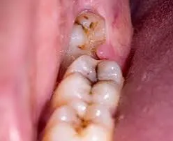 Impacted wisdom tooth surgery at Revive Dental, Banashankari 6th Stage