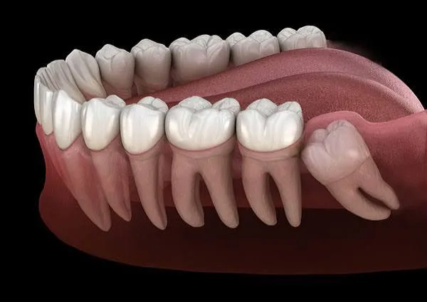 X-ray review before impacted tooth removal near Konanakunte