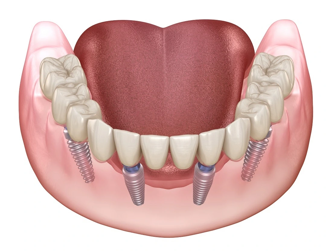 Dental implants and full mouth rehabilitation at Revive Dental