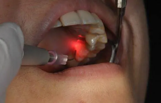 Laser surgery procedure on gum tissue near Vajarahalli
