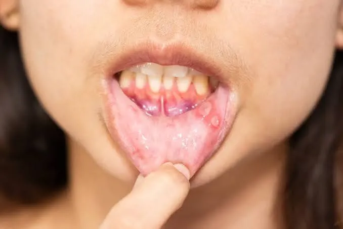 Leukoplakia diagnosis and treatment at Revive Dental