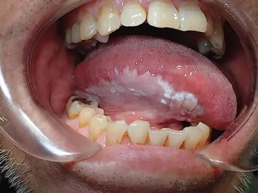Close examination of a white patch in the mouth