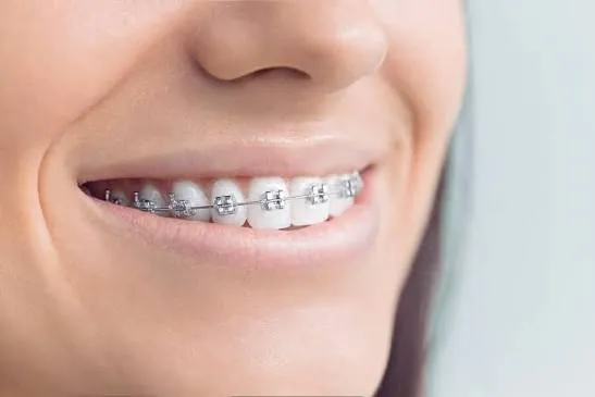 Metal braces orthodontic treatment at Revive Dental, Vajarahalli