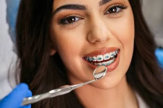 Close-up of stainless-steel metal braces on teeth
