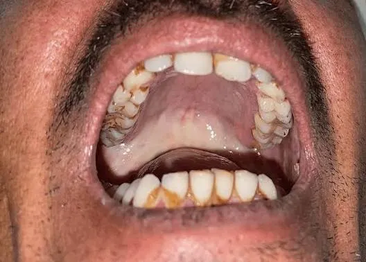 OSMF (Oral Submucous Fibrosis) treatment at Revive Dental