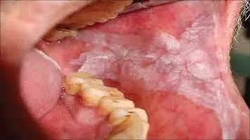Examination of mouth opening for OSMF