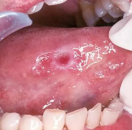 Dentist checking oral tissue during cancer screening near Thalaghattapura