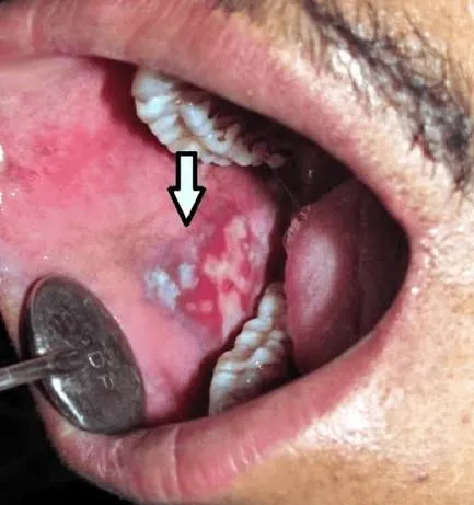 Oral Lichen Planus management at Revive Dental