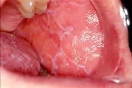 Clinical review of lace-like white patches in the mouth