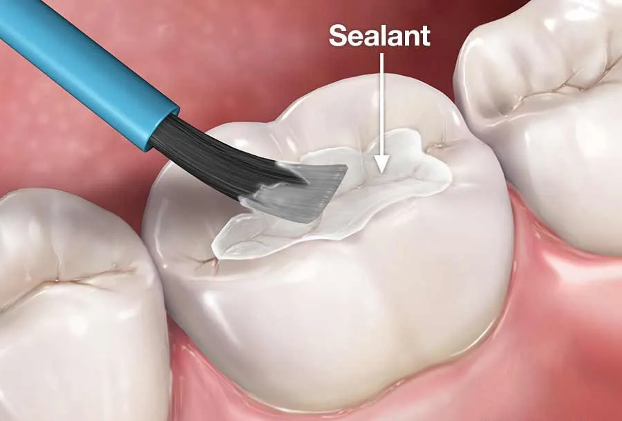 Close-up of dental sealant application on back molars