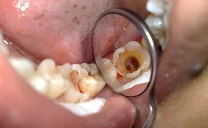Pulpectomy treatment on a child's baby tooth at Revive Dental, Banashankari