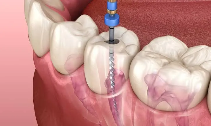 Dentist performing a gentle pulpectomy procedure on a baby tooth