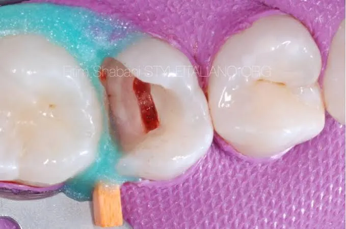 Pulpotomy treatment on a child's baby tooth at Revive Dental, Vajarahalli