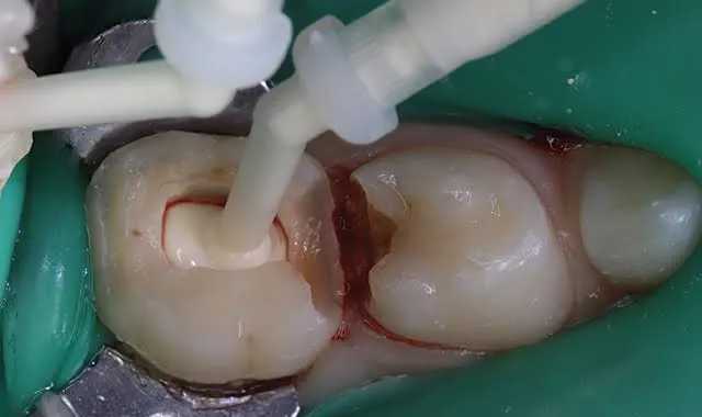 Dentist performing a pulpotomy procedure on a baby tooth