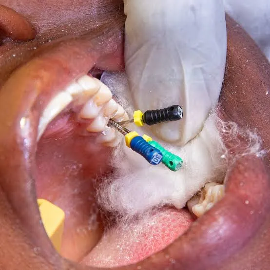 Root canal procedure close up