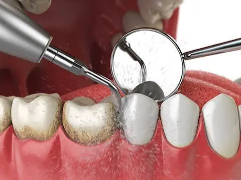 Professional oral prophylaxis procedure at Revive Dental clinic