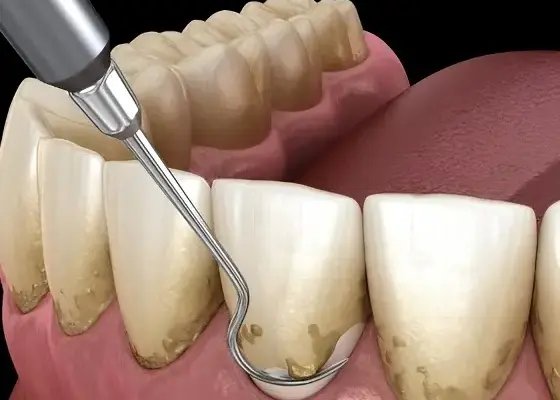 Tooth cleaning treatment at Revive Dental, Vajarahalli